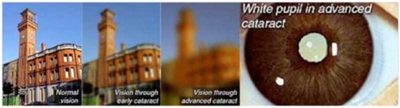 Types of lens at Vatsal eye care | Cataract Treatment in Vasai