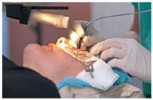 Best Laser operation for Eyes | Lasik Eye Treatment